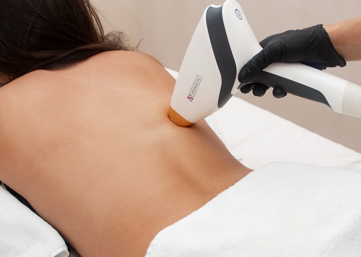 Laser-Haarentfernung